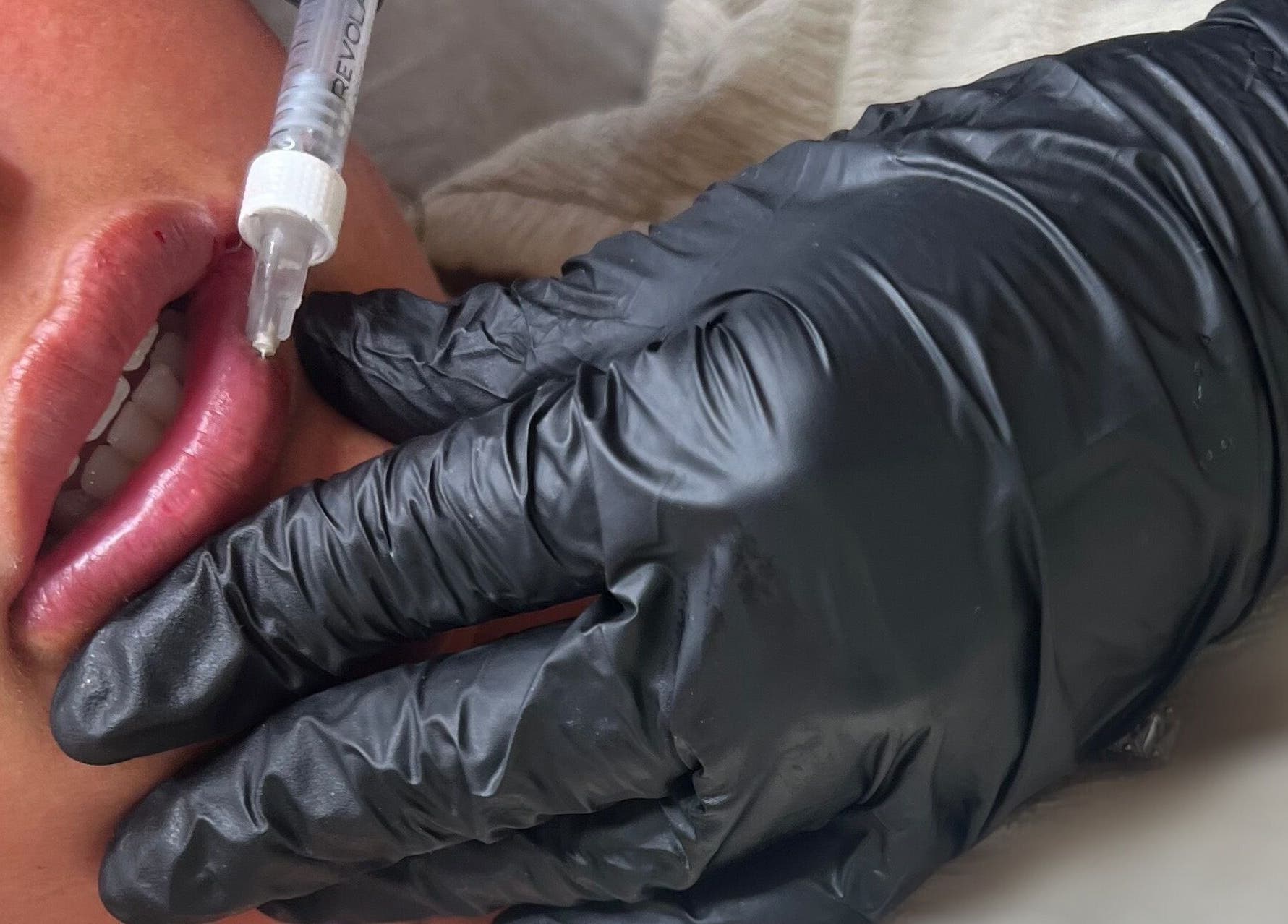 Professional lip filler procedure at Vienna Aesthetics in Reigate, England, GB.