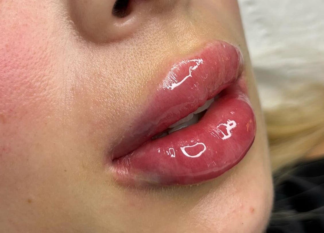 Close-up of glossy lips from Vienna Aesthetics, Reigate, England, GB showcasing expert lip enhancement.