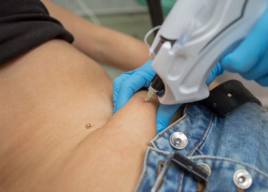 Skin treatment at Aesthetic Medical LTD, Trowbridge, England, GB, using advanced equipment.