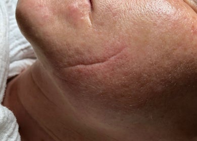 Nahaufnahme einer Hautbehandlung bei CARRIE’S COSMETIC | Kosmetikstudio Hamburg & Permanent Make-up Eppendorf, Hamburg, DE.