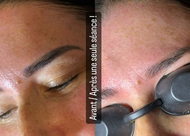 Avant et après traitement facial TY BEAUTÉ, VANNES, FR, illustrant un soin de beauté professionnel.