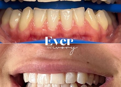Before and after teeth whitening at Ever and Ivory - Teeth Whitening and Tooth Gems, Pimpama, Queensland, AU.