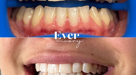 Before and after teeth whitening at Ever and Ivory - Teeth Whitening and Tooth Gems, Pimpama, Queensland, AU.