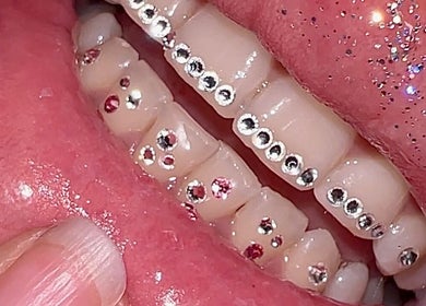 Sparkling tooth gems at Ever and Ivory - Teeth Whitening and Tooth Gems, Pimpama, Queensland, AU.