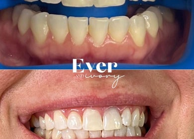 Ever and Ivory - Teeth Whitening and Tooth Gems in Pimpama, Queensland, AU showcases before and after teeth results.