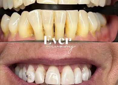 Before and after teeth whitening at Ever and Ivory - Teeth Whitening and Tooth Gems, Pimpama, Queensland, AU.