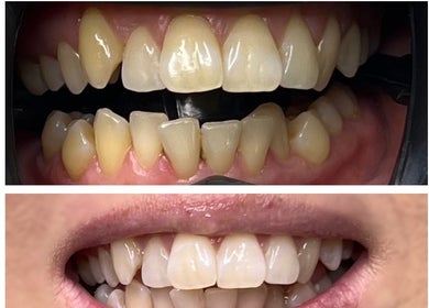 Before and after teeth whitening at Ever and Ivory - Teeth Whitening and Tooth Gems, Pimpama, Queensland, AU.