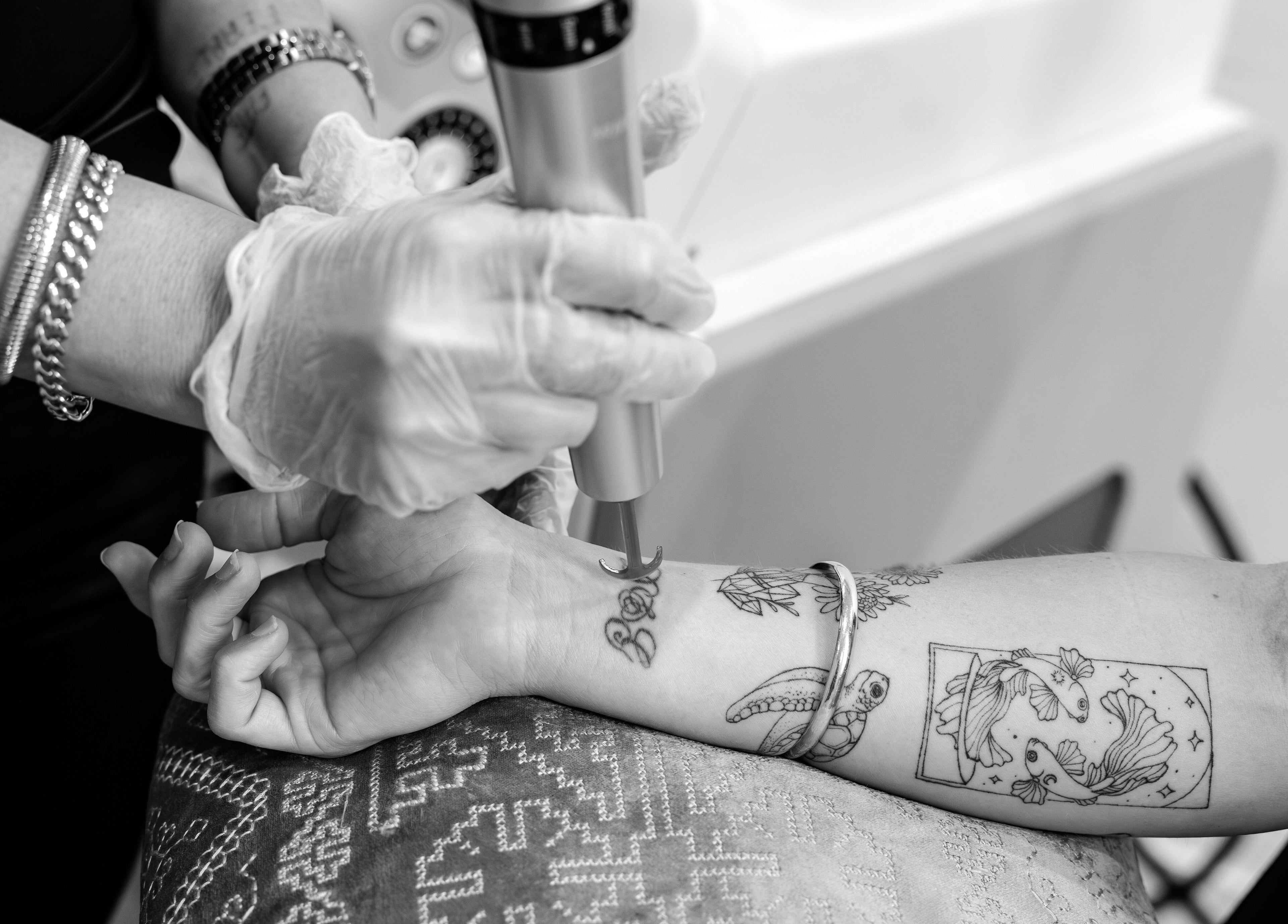 Tattoo removal at Lase Away in Coffs Harbour, New South Wales, AU. Expert laser treatment shown.