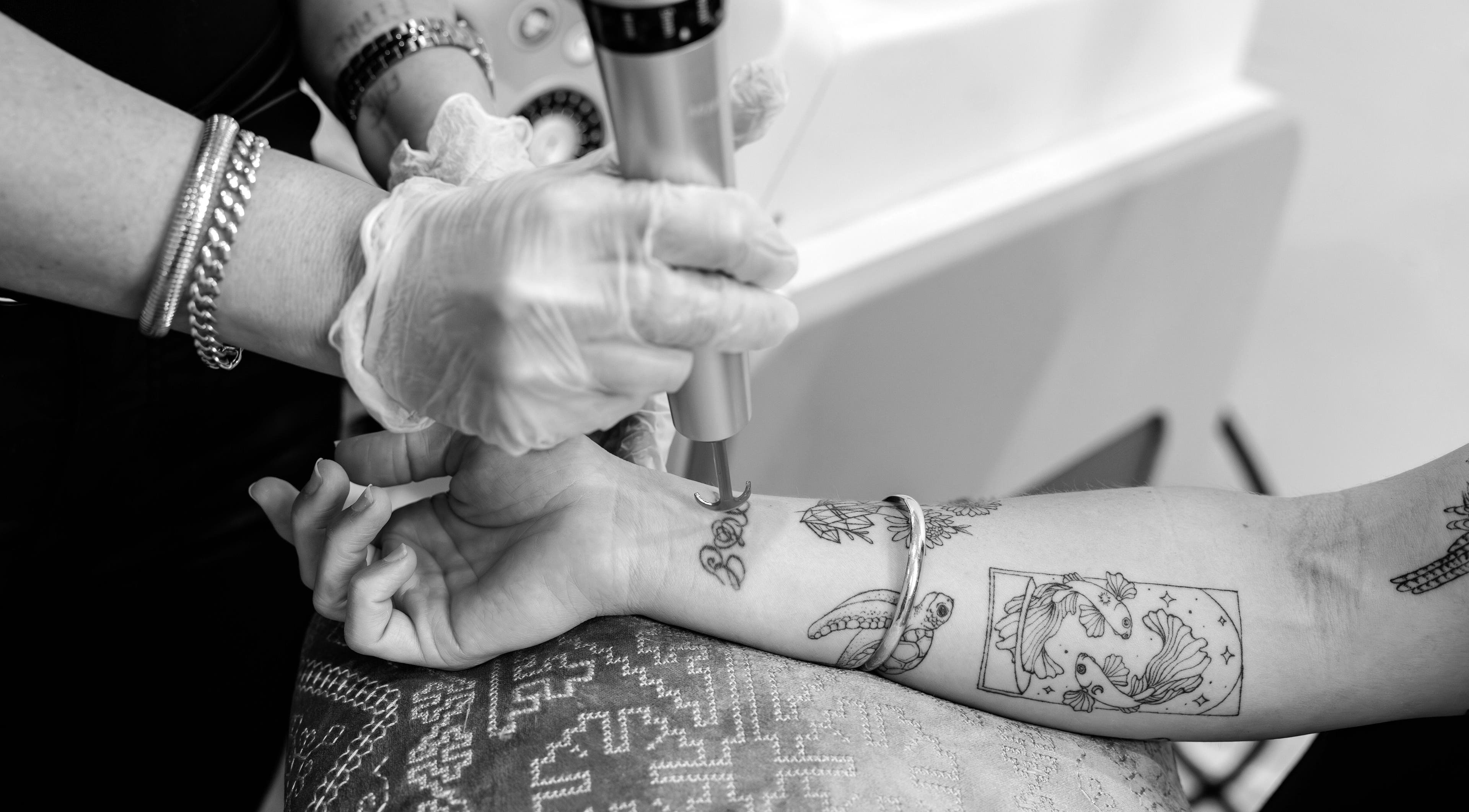 Tattoo removal at Lase Away in Coffs Harbour, New South Wales, AU. Expert laser treatment shown.