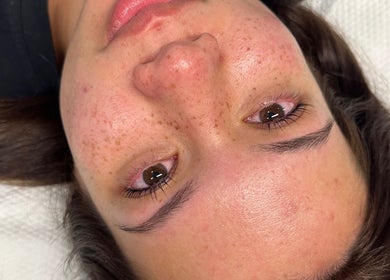 Close-up of glowing skin after treatment at Aura Aesthetics, Thornlands, Queensland, AU.