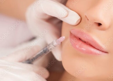 Lip filler treatment at Skin and Drip, London, England, GB, showcasing subtle enhancement.