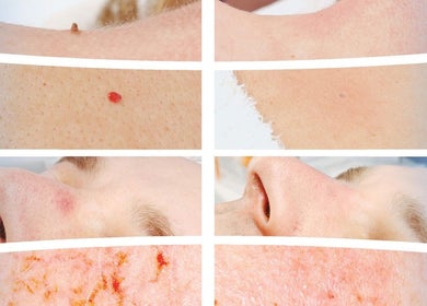 Before and after skin treatments at Sydney Mobile Medispa, Kings Park, New South Wales, AU.