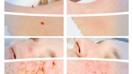 Before and after skin treatments at Sydney Mobile Medispa, Kings Park, New South Wales, AU.