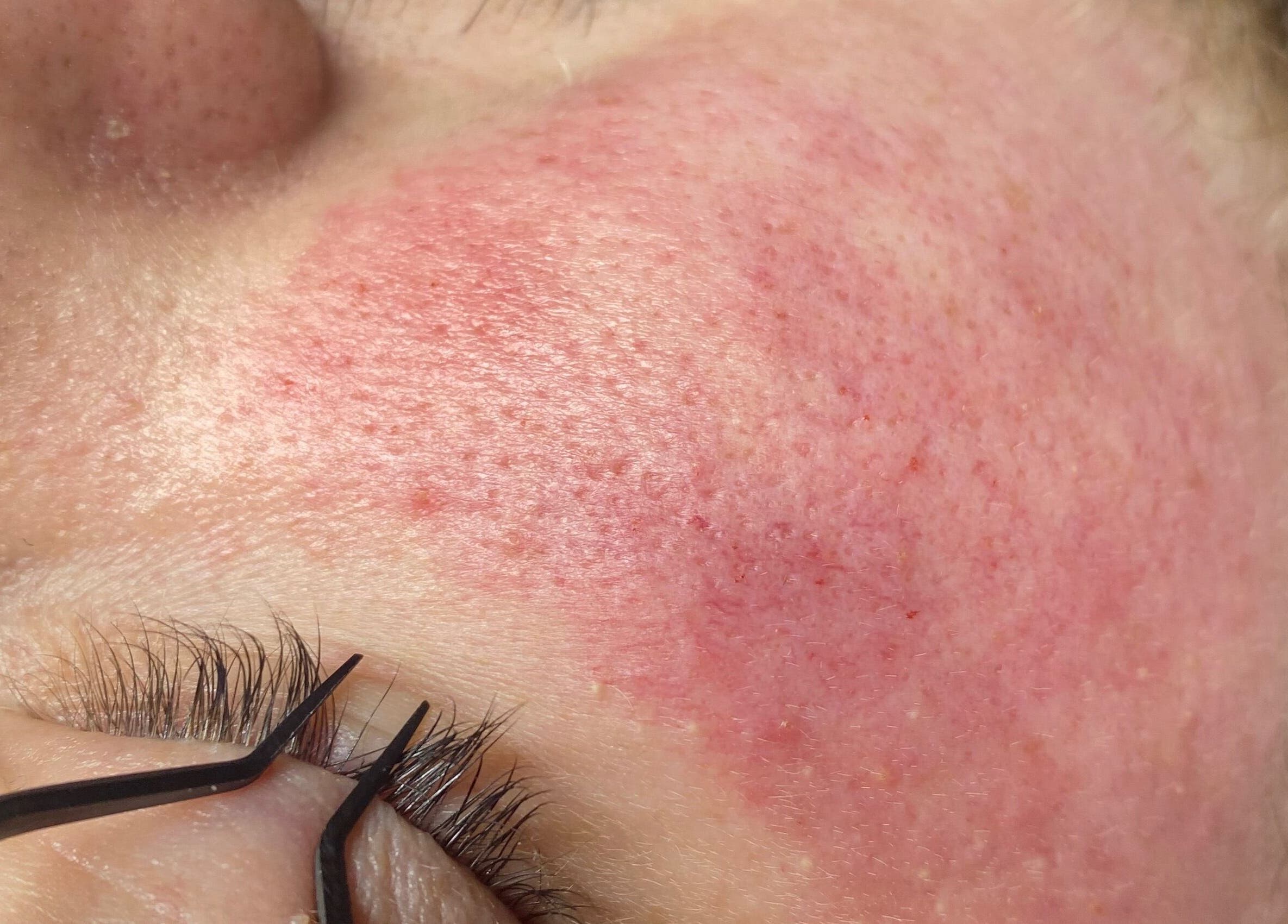 Close-up of radiant skin after treatment at Diversity Skin & Beauty Studio, Pontypool, Wales, GB.