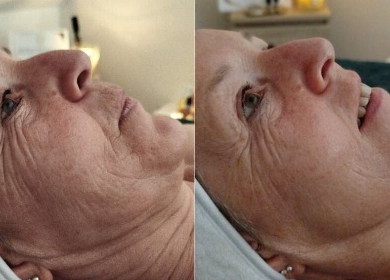 Avant-après soin visage à LMC le moment cocooning à Vair-sur-loire, Pays De La Loire, FR.