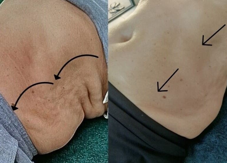 Avant-après traitement corporel à LMC le moment cocooning à domicile, Vair-sur-loire, Pays De La Loire, FR.