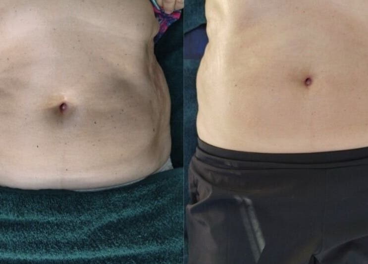 Comparaison du ventre avant-après soin minceur chez LMC le moment cocooning à domicile, Vair-sur-loire, Pays De La Loire, FR.