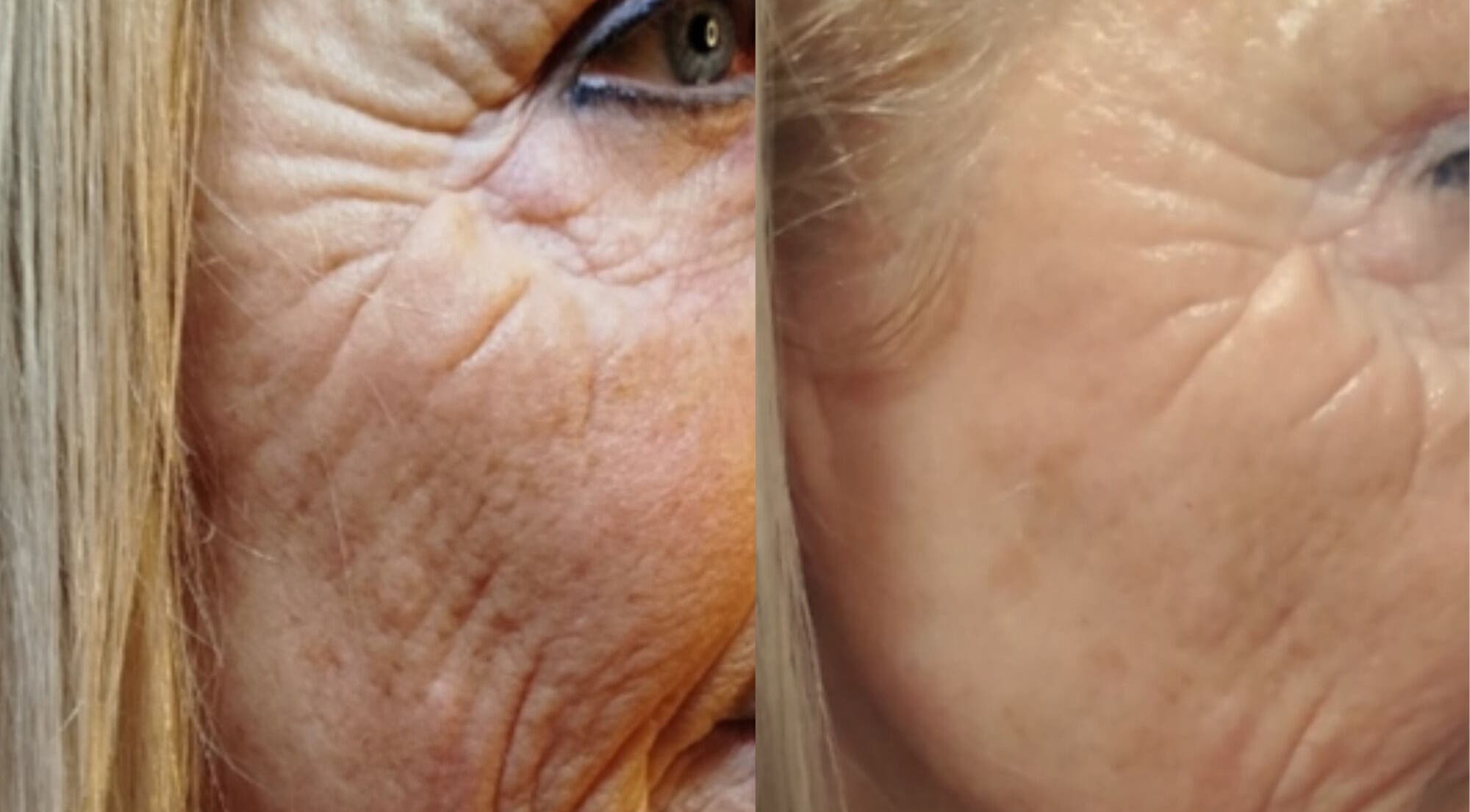 Résultat avant-après soin anti-âge à LMC Le Moment Cocooning, Vair-sur-loire, Pays De La Loire, FR.