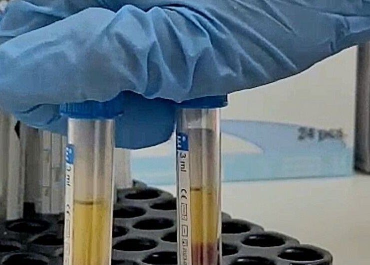 Close-up of lab glove holding test tubes at Stella Medical Aesthetics, Dublin, County Dublin, IE.