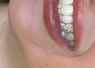 Dazzling tooth gems at DOLLY DENTAL - TEETH WHITENING & TOOTH GEMS in Maroochy River, Queensland, AU.