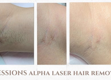 Before and after laser hair removal at The Face Manor Inc., Windsor, Ontario, CA showing visible smooth results.