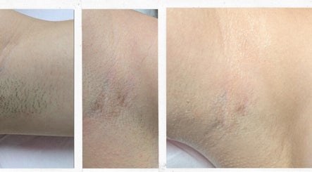 Underarm hair removal results at The Face Manor Inc., Windsor, Ontario, CA: before and after photos.