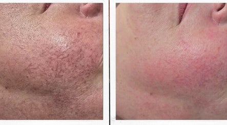 Before and after skin treatment at The Face Manor Inc., Windsor, Ontario, CA, showcasing smoothened complexion.