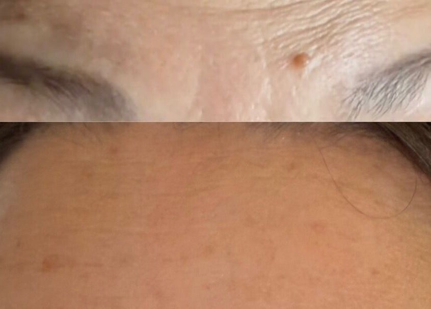 Before and after skin treatment at Summer Eva Cranswick, Hutton Cranswick, England, GB.