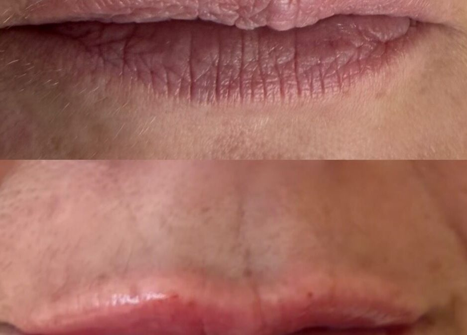 Before and after lip treatment at Summer Eva Cranswick, Hutton Cranswick, England, GB showcasing enhanced lips.