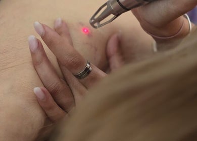 Close-up of a laser treatment at Fabulaze Beauty Studio, Cape Town, Western Cape, ZA.