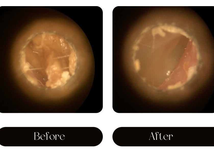 Before and after ear cleaning at Jrapha Earfix & Travel Clinic, Wellingborough, England, GB.