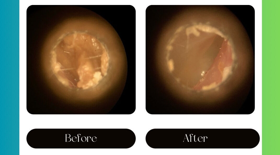 Before and after ear cleaning at Jrapha Earfix & Travel Clinic, Wellingborough, England, GB.