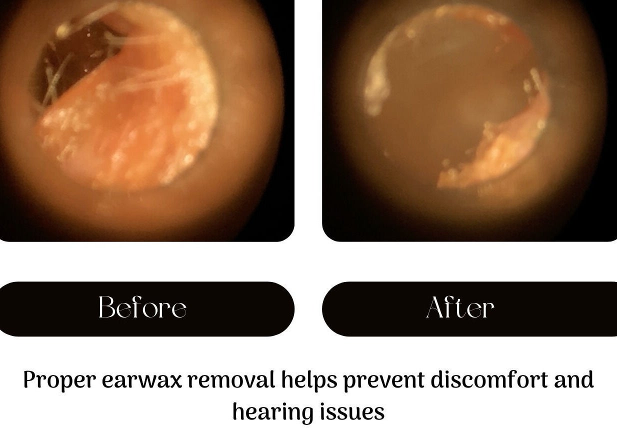 Before and after earwax removal at Jrapha Earfix & Travel Clinic, Wellingborough, England, GB.