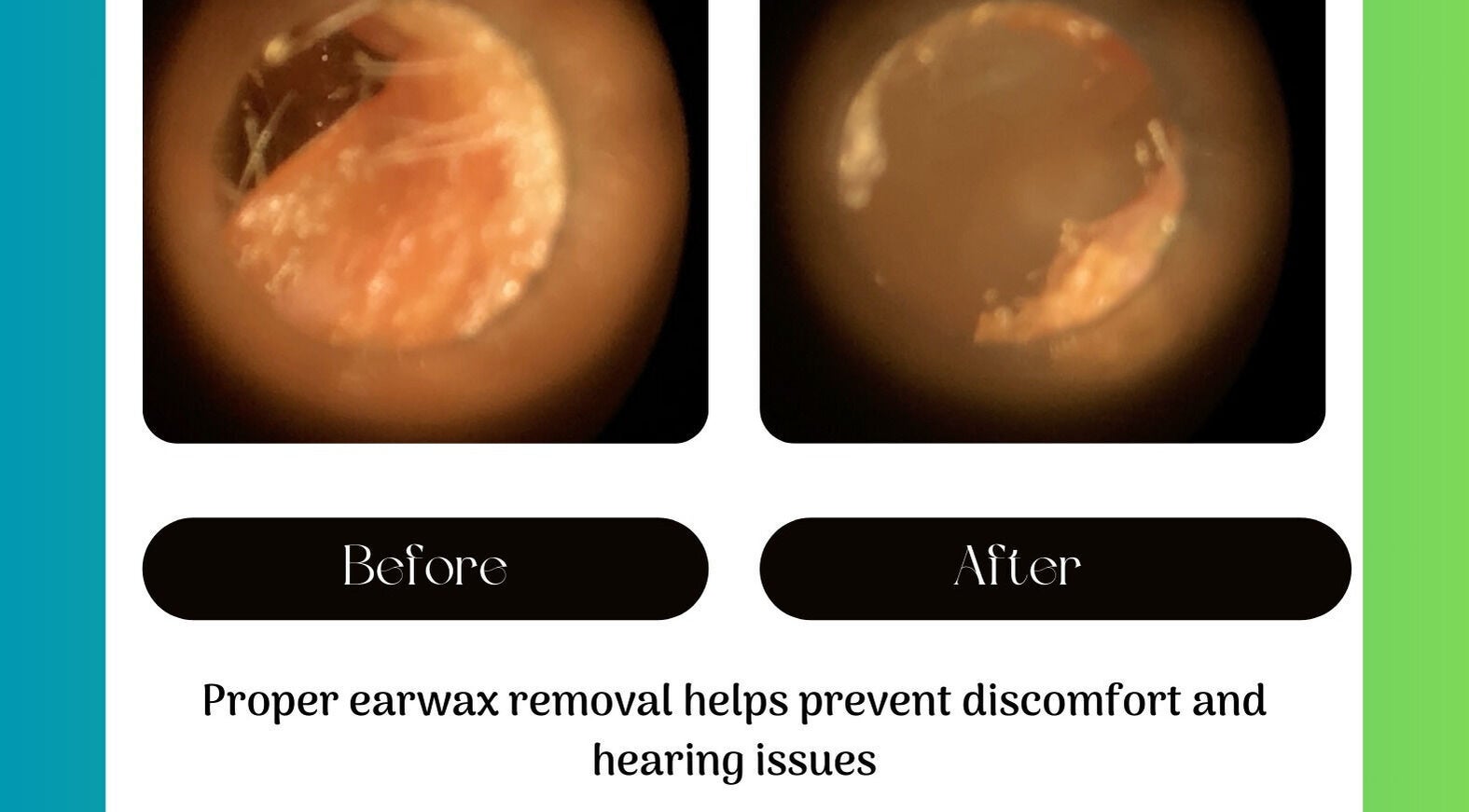Before and after earwax removal at Jrapha Earfix & Travel Clinic, Wellingborough, England, GB.