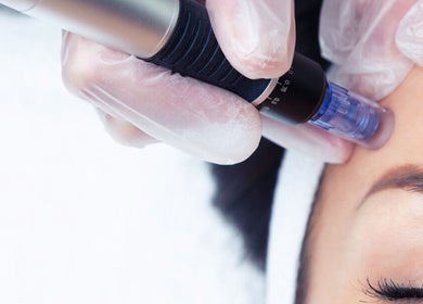 Microneedling-Behandlung bei KS Beauty Studio, Murg/Hänner, Baden-Württemberg, DE.