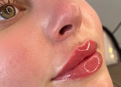 Close-up of glossy lips after treatment at H Derma Beauti Aesthetics Norwich, Norwich, England, GB.