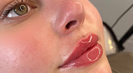 Close-up of glossy lips after treatment at H Derma Beauti Aesthetics Norwich, Norwich, England, GB.