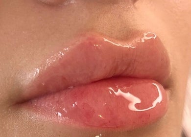 Close-up of glossy lips treatment at H Derma Beauti Aesthetics Norwich, located in Norwich, England, GB.