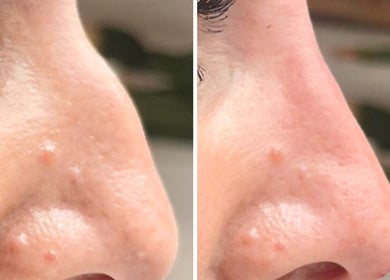 Before and after skin treatment at H Derma Beauti Aesthetics Norwich, showcasing smoother skin results in Norwich, England, GB.
