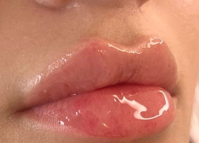 Plump, glossy lips at H Derma Beauti Aesthetics Norwich, enhancing beauty in Norwich, England, GB.