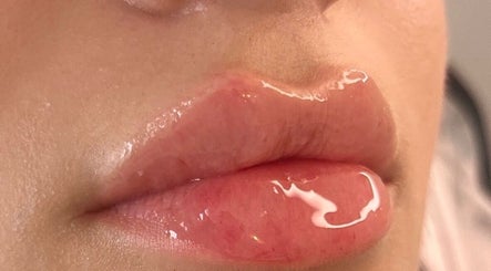 Plump, glossy lips at H Derma Beauti Aesthetics Norwich, enhancing beauty in Norwich, England, GB.