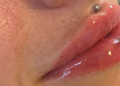 Enhanced lips with piercings at H Derma Beauti Aesthetics Norwich, Norwich, England, GB.