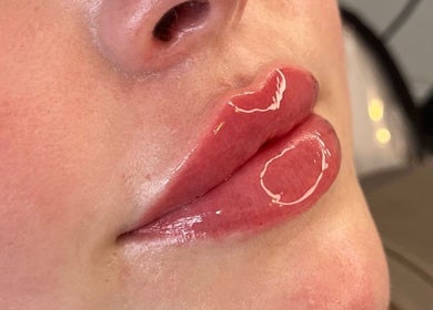 Plump, glossy lips after a treatment at H Derma Beauti Aesthetics Norwich, Norwich, England, GB.