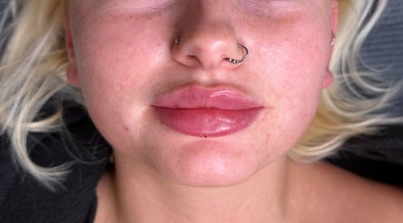 Lip enhancement at Nadia Skin And Aesthetics, showcasing vibrant lips in Stoke-on-Trent, England, GB.