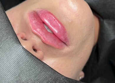 Close-up of glossy lips treatment at Nadia Skin And Aesthetics, Stoke-on-Trent, England, GB.