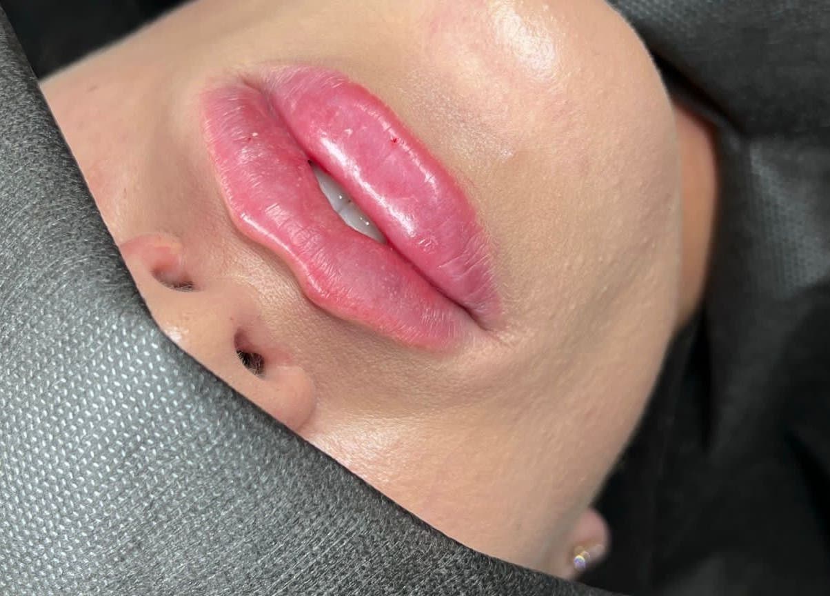 Close-up of enhanced lips at Nadia Skin And Aesthetics in Stoke-on-Trent, England, GB.
