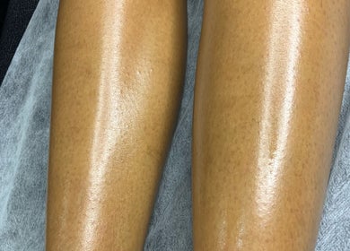 Smooth legs after treatment at Bare Skin Studio, St James, Port of Spain Corporation, TT