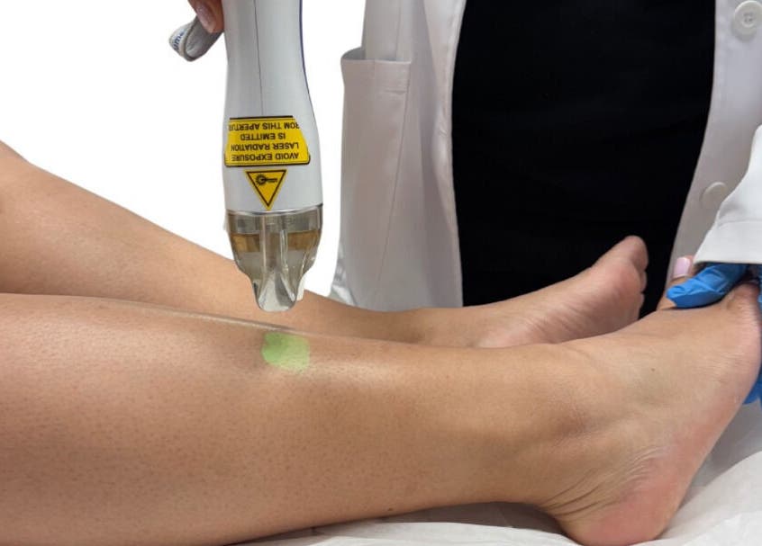 Leg laser treatment at Kate Cosmedici Spa - Rockville, Maryland, US for smooth skin.