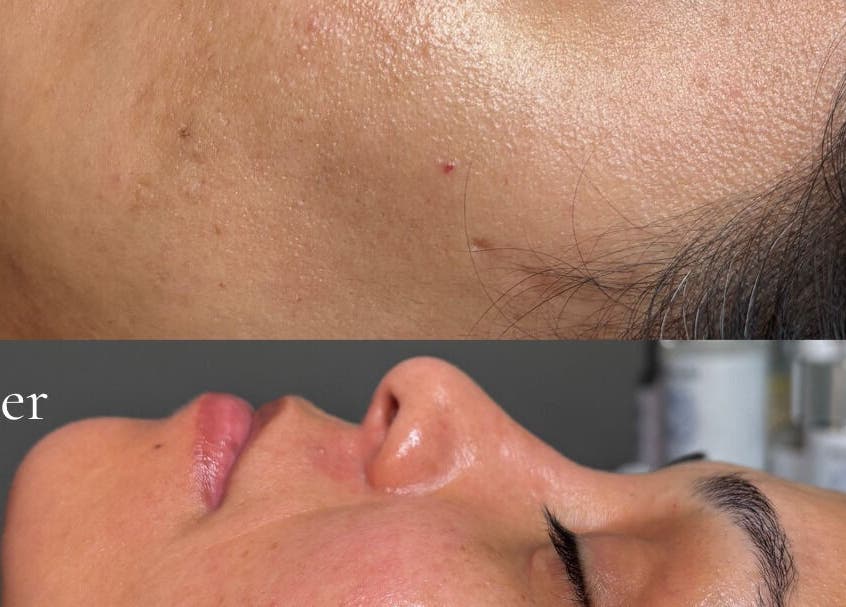 Before and after skincare treatment at Kate Cosmedici Spa - Rockville, Rockville, Maryland, US showing clear skin transformation.
