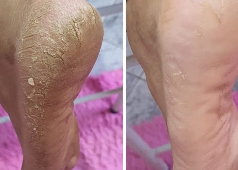 Transformação dos calcanhares na Studio Maira Gomes, Fafe, Braga, PT, mostrando antes e depois do tratamento.